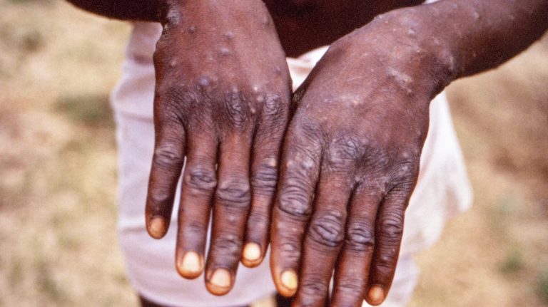 New Pandemic? Mpox Cases Near 100,000 Worldwide