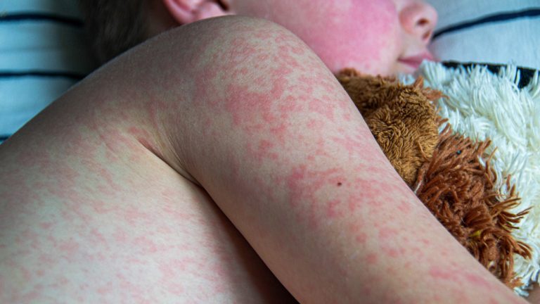 Measles Cases Surge Worldwide, Infecting 10.3 Million People In 2023